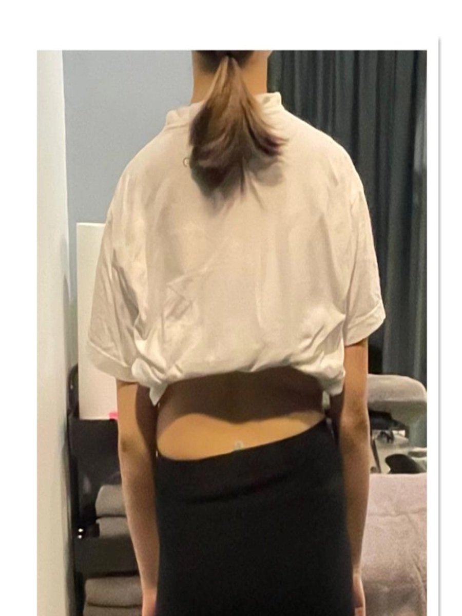 Before - Shoulder Pain and Mobility Recovery